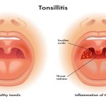 How-to-Get-Rid-of-Tonsil-Stones-Naturally1