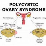 How to diagnose polycystic ovary syndrome