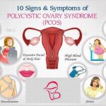 Signs of polycystic ovary