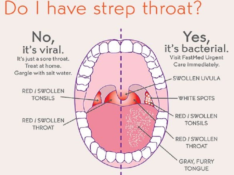 What is strep throat? symptoms, causes, treatments, diagnose, prevent