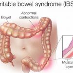 What is irritable bowel syndrome (IBS) Causes, Treatments, Diet is