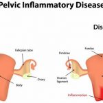 What is pelvic inflammatory disease