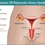 What is polycystic ovary syndrome
