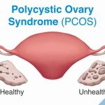 What is polycystic ovary syndrome1