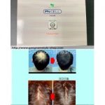 How PDRN does helps for hair growth