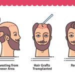 Hair Transplant- The solution for hair loss