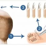 Hair Transplant- The solution for hair loss2
