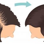Hair Transplant- The solution for hair loss7