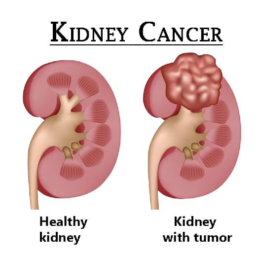 Dr. Sandeep Nayak: A Laparoscopic Surgery Expert for Kidney Cancer ...